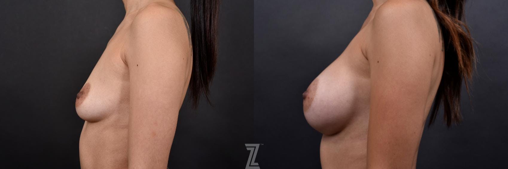 Breast Augmentation Before & After Gallery - Patient 132790713 - Image 3