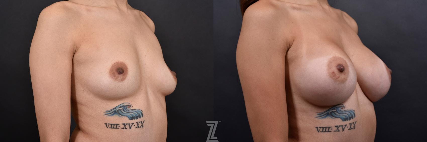 Breast Augmentation Before & After Gallery - Patient 132790713 - Image 4