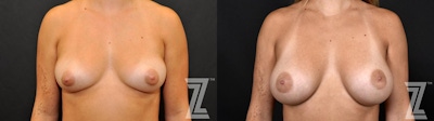 Breast Augmentation Before & After Gallery - Patient 132790714 - Image 1