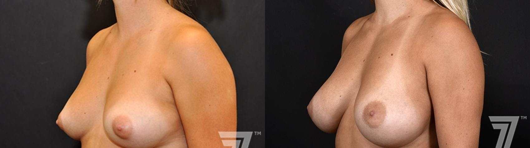 Breast Augmentation Before & After Gallery - Patient 132790714 - Image 2