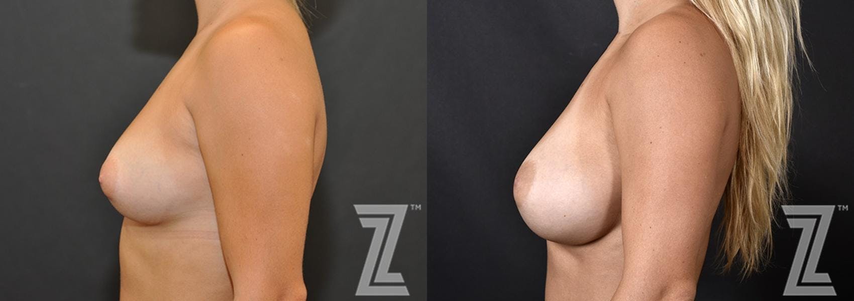 Breast Augmentation Before & After Gallery - Patient 132790714 - Image 3