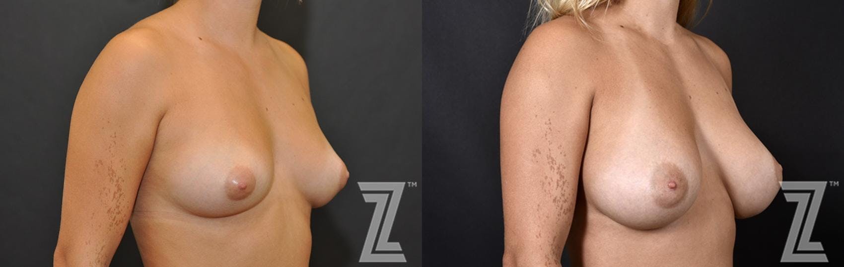 Breast Augmentation Before & After Gallery - Patient 132790714 - Image 4