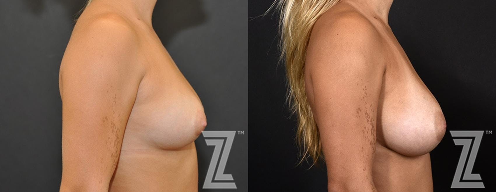 Breast Augmentation Before & After Gallery - Patient 132790714 - Image 5