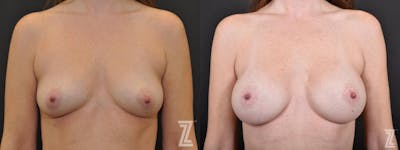 Austin Frontal View of before and after 33 year old women with Silicone Implants with Cohesive Silicone Gel at the Piazza center - The Piazza Center