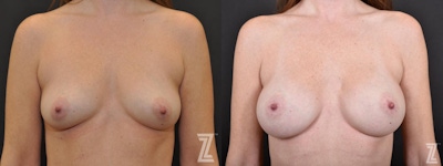 Breast Augmentation Before & After Gallery - Patient 132790715 - Image 1