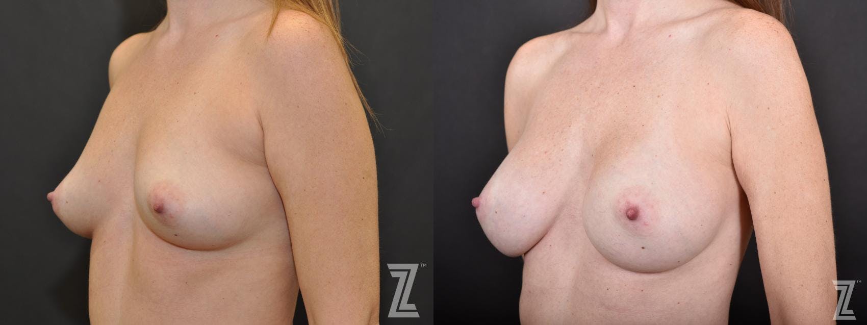 Breast Augmentation Before & After Gallery - Patient 132790715 - Image 2