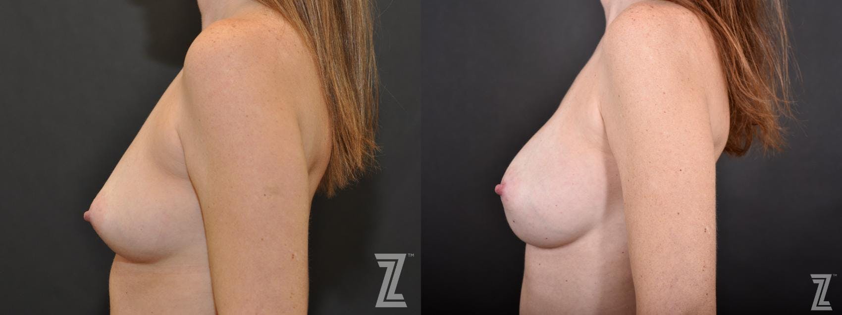 Breast Augmentation Before & After Gallery - Patient 132790715 - Image 3
