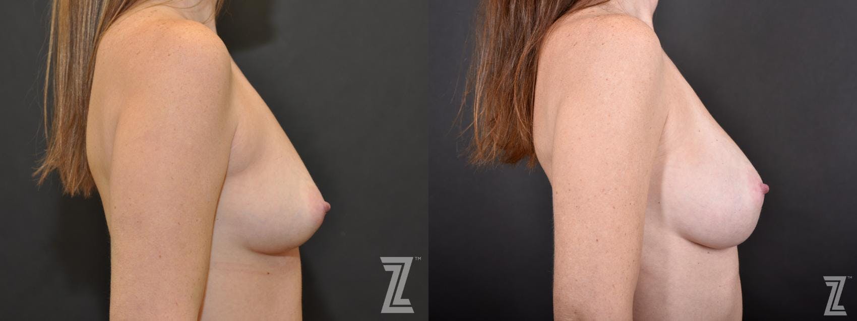 Breast Augmentation Before & After Gallery - Patient 132790715 - Image 5