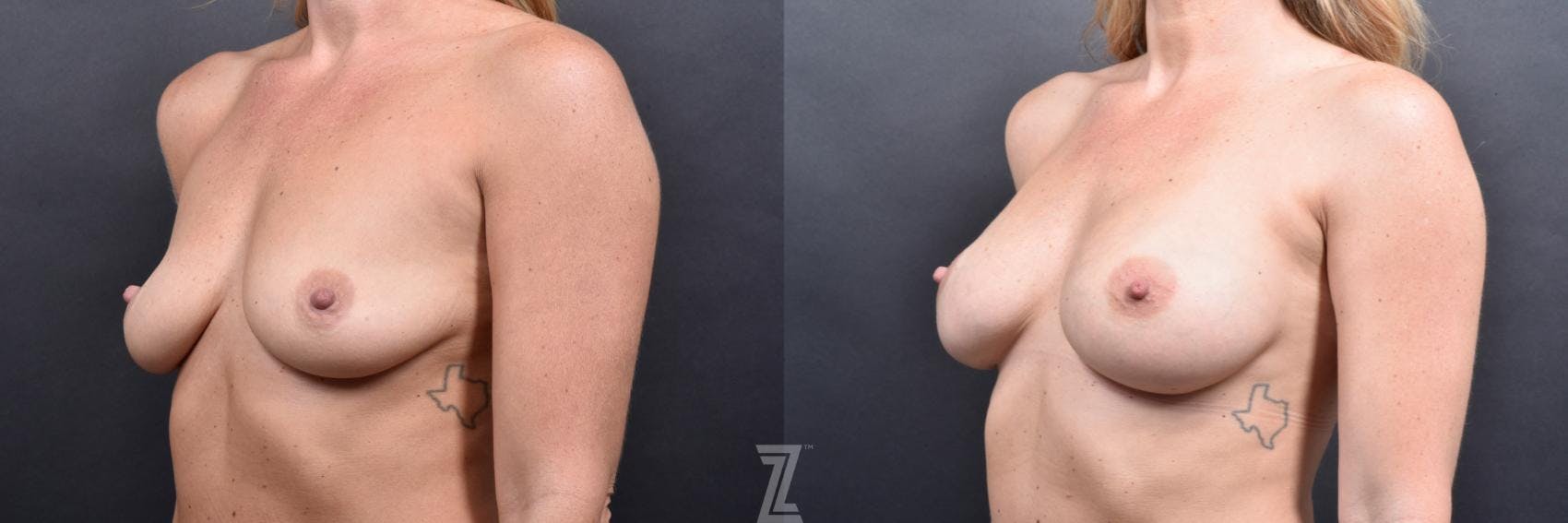 Breast Augmentation Before & After Gallery - Patient 132790717 - Image 2