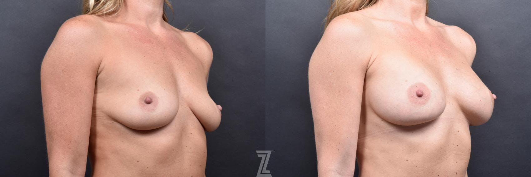 Breast Augmentation Before & After Gallery - Patient 132790717 - Image 4