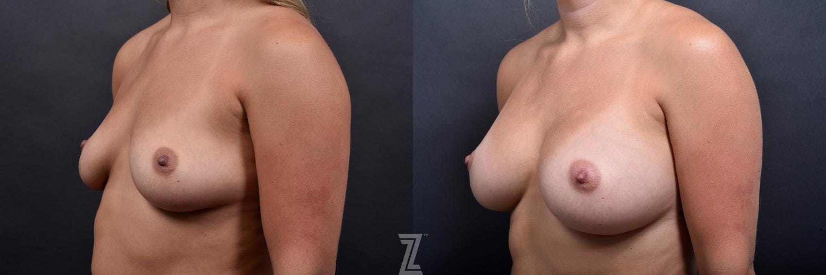 Breast Augmentation Before & After Gallery - Patient 132790724 - Image 2
