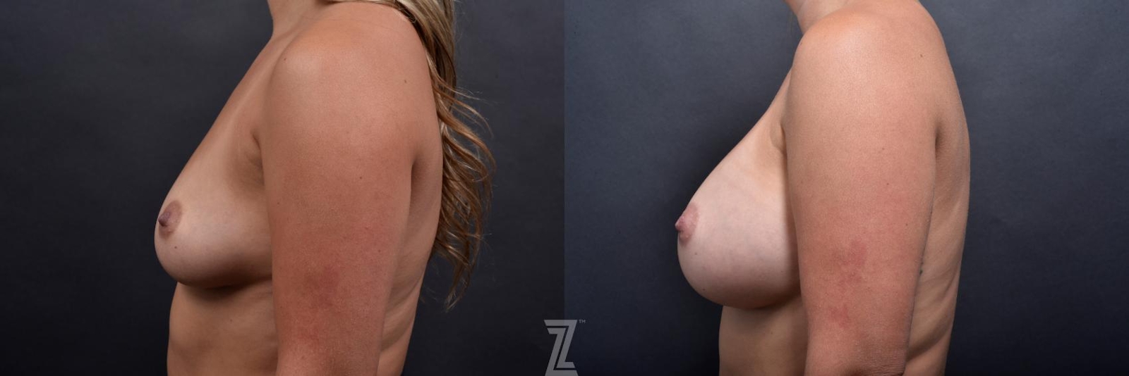 Austin Side view Before and after image of 27 year old woman with breast augmentation - Dr. Rocco C. Piazza - The Piazza Center