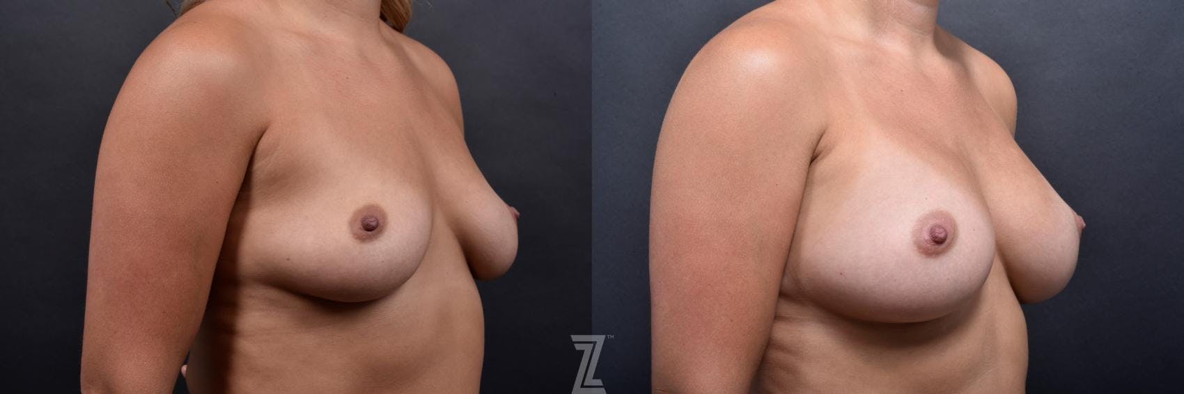 Breast Augmentation Before & After Gallery - Patient 132790724 - Image 4