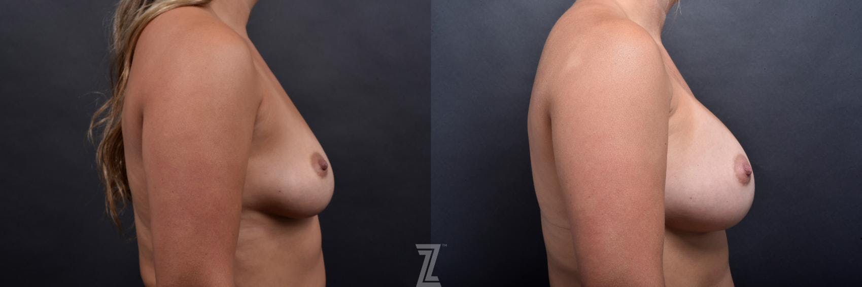 Breast Augmentation Before & After Gallery - Patient 132790724 - Image 5