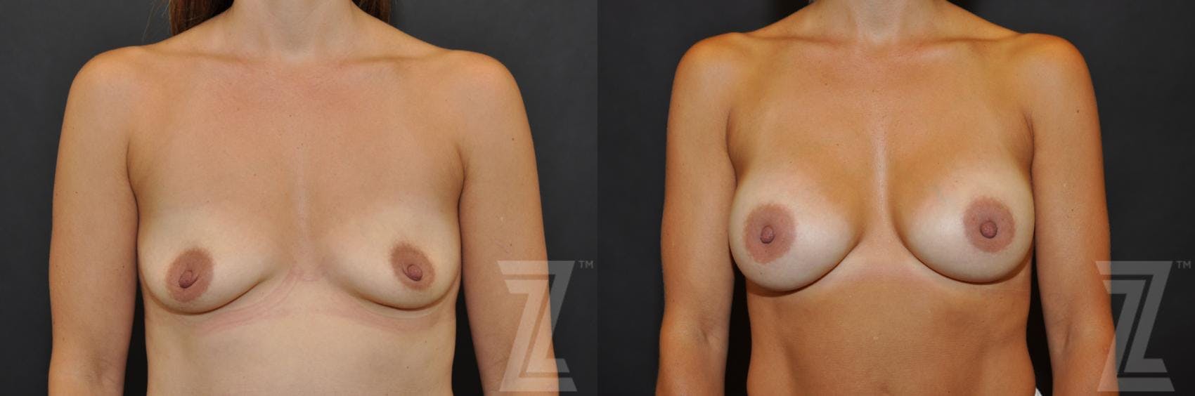 Breast Augmentation Before & After Gallery - Patient 132790726 - Image 1