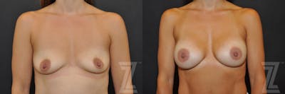 Austin front view before and after image of 36-year-old mother of four breast augmentation at the piazza center - The Piazza Center
