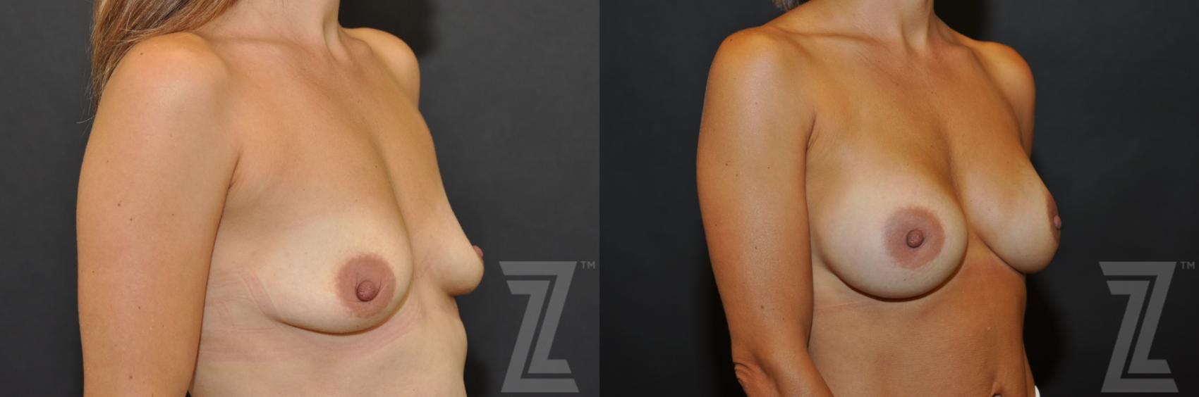 Breast Augmentation Before & After Gallery - Patient 132790726 - Image 4