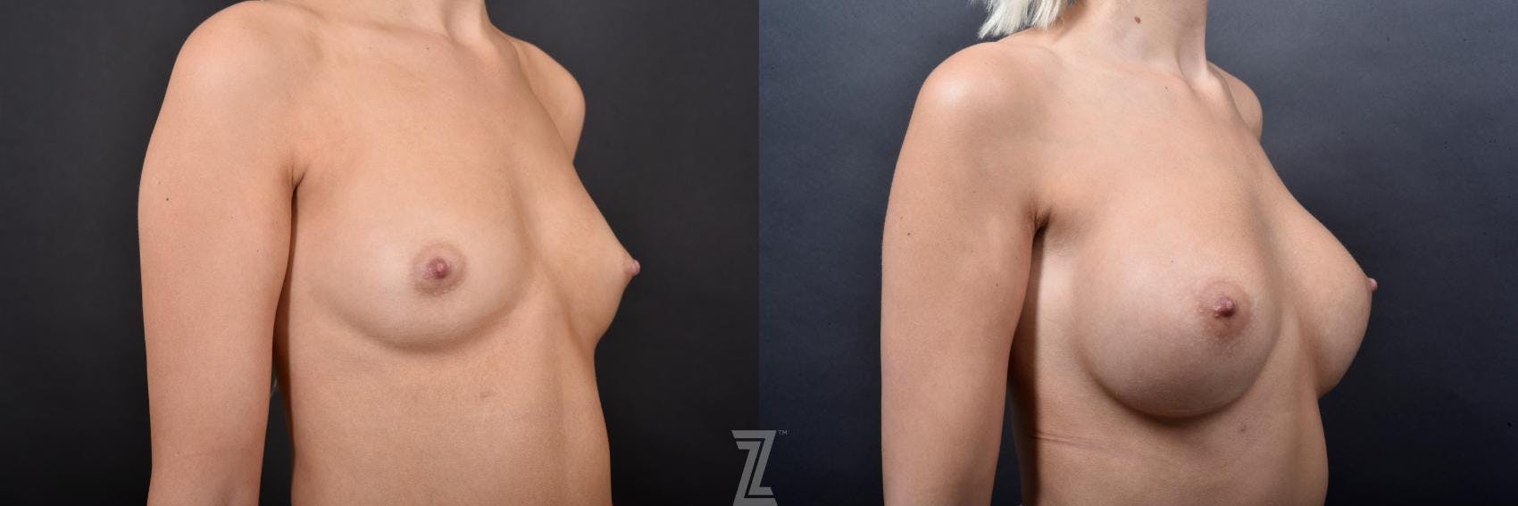 Breast Augmentation Before & After Gallery - Patient 132790727 - Image 4