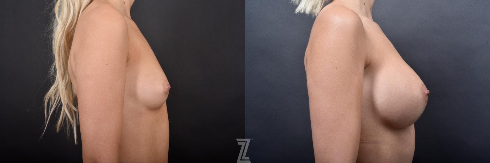 Breast Augmentation Before & After Gallery - Patient 132790727 - Image 5