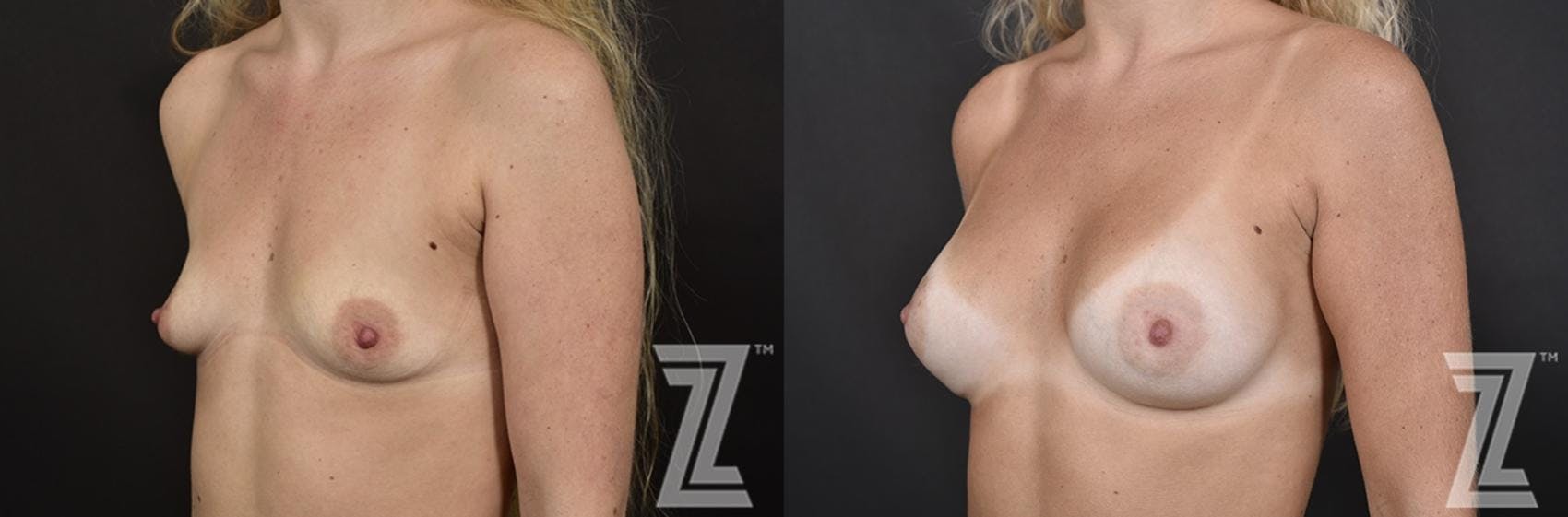 Breast Augmentation Before & After Gallery - Patient 132790732 - Image 2