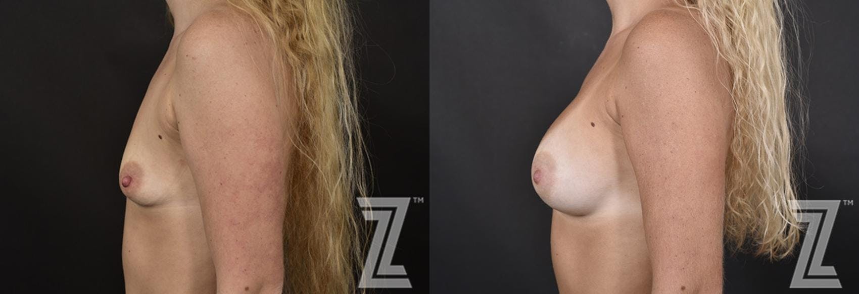 Breast Augmentation Before & After Gallery - Patient 132790732 - Image 3