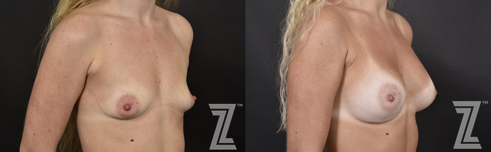 Breast Augmentation Before & After Gallery - Patient 132790732 - Image 4