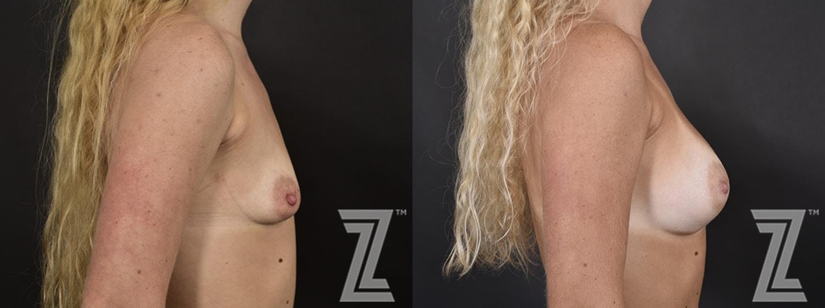 Breast Augmentation Before & After Gallery - Patient 132790732 - Image 5