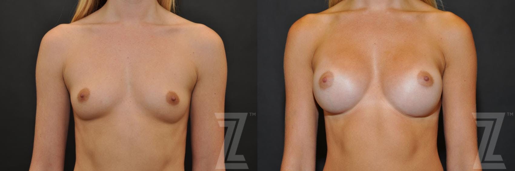 Breast Augmentation Before & After Gallery - Patient 132790733 - Image 1