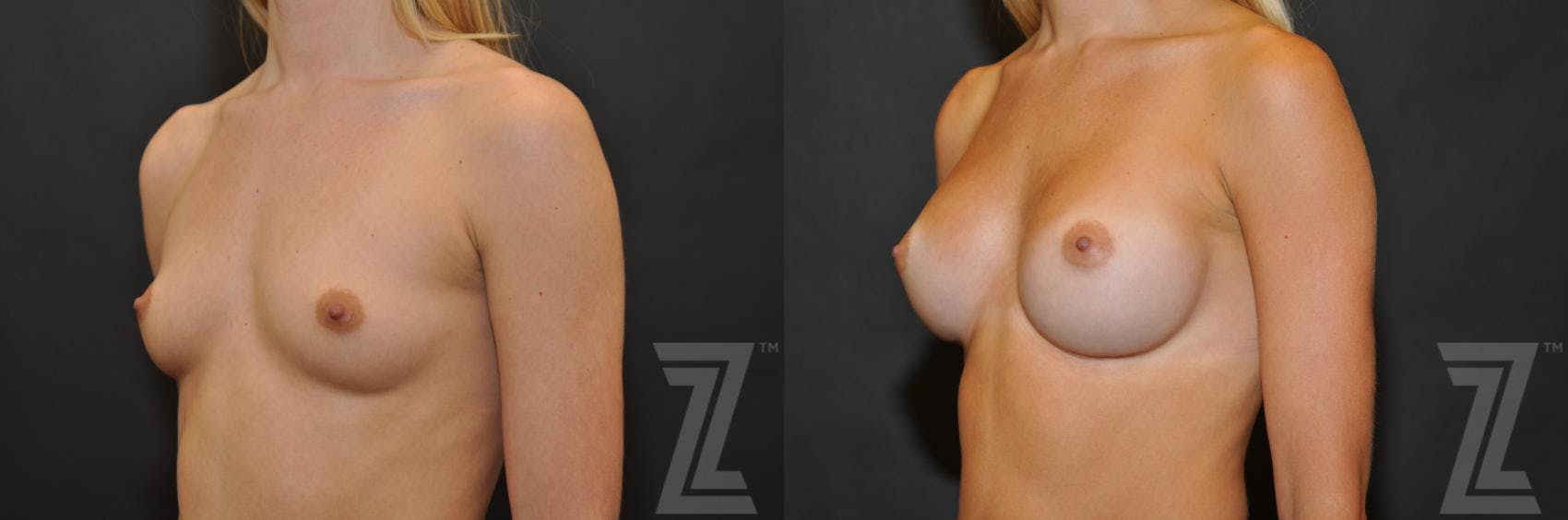 Breast Augmentation Before & After Gallery - Patient 132790733 - Image 2