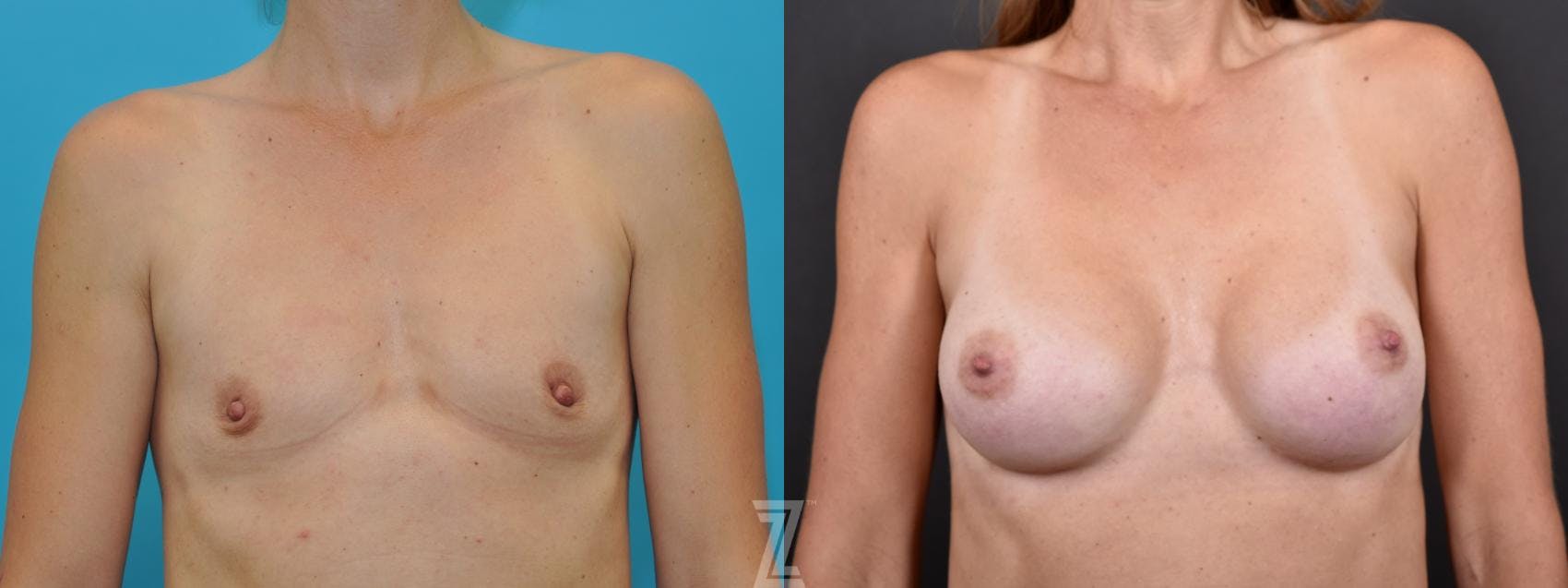 Breast Augmentation Before & After Gallery - Patient 132790736 - Image 1