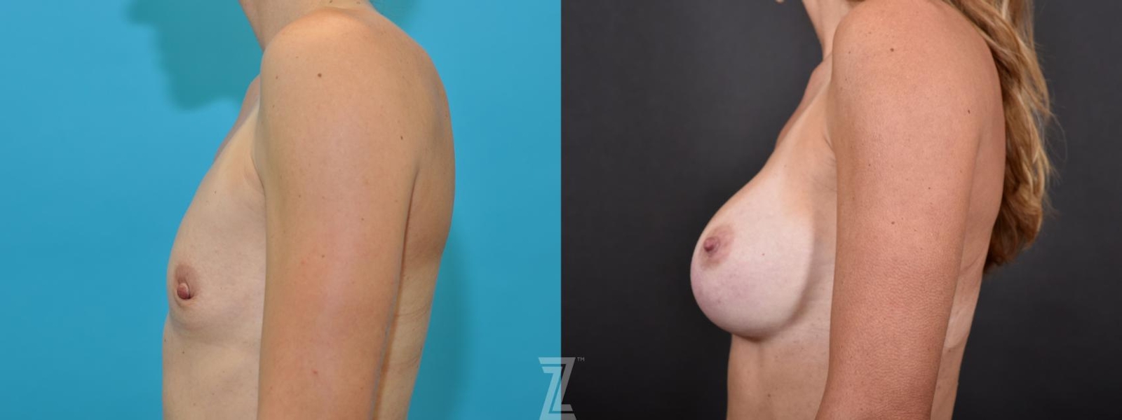 Austin Side view of Before and After 5 year post op of Silicone Implants with Highly Cohesive Gel (Gummy Bear Implants) - The Piazza Center