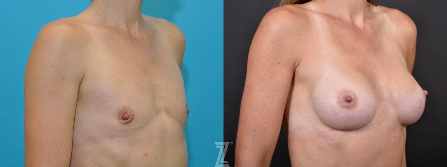 Breast Augmentation Before & After Gallery - Patient 132790736 - Image 4