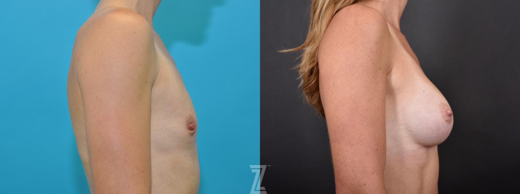 Breast Augmentation Before & After Gallery - Patient 132790736 - Image 5