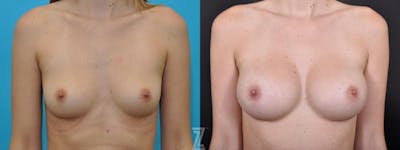 Austin Bilateral before and after image of 25 year old woman with Silicone Implants with Highly Cohesive Gel (Gummy Bear Implants) - The Piazza Center