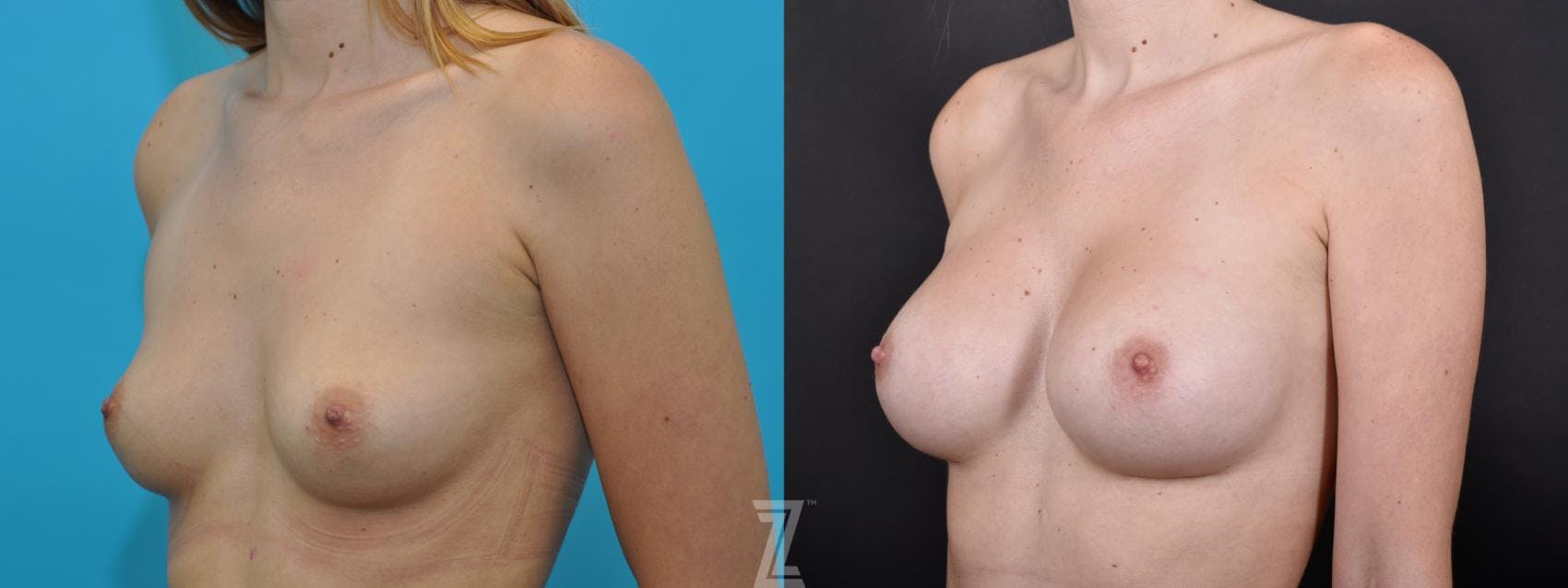 Breast Augmentation Before & After Gallery - Patient 132790738 - Image 2