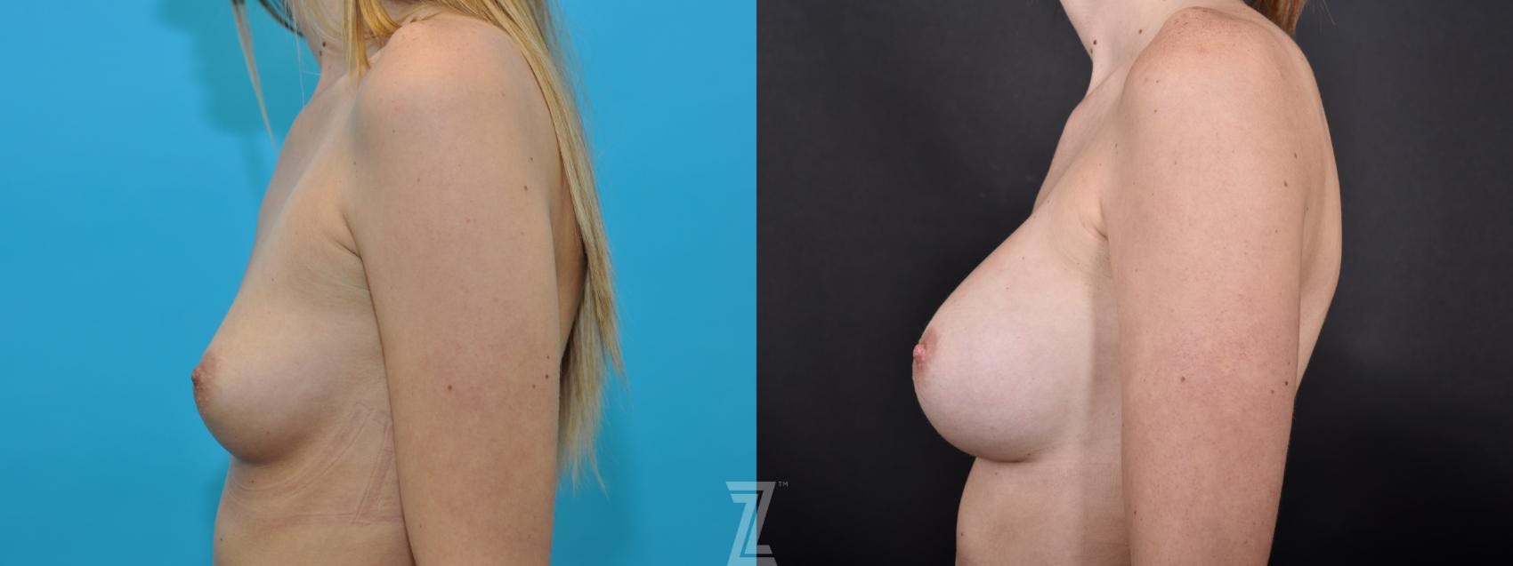 Breast Augmentation Before & After Gallery - Patient 132790738 - Image 3