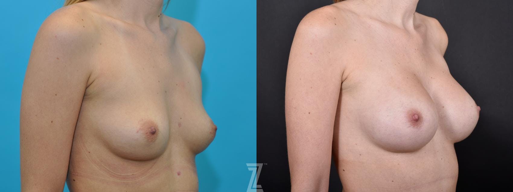 Breast Augmentation Before & After Gallery - Patient 132790738 - Image 4