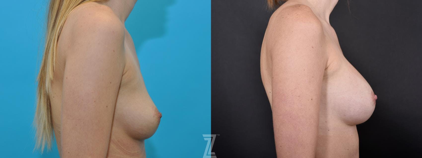 Breast Augmentation Before & After Gallery - Patient 132790738 - Image 5