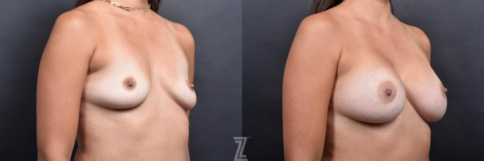 Breast Augmentation Before & After Gallery - Patient 132790740 - Image 4