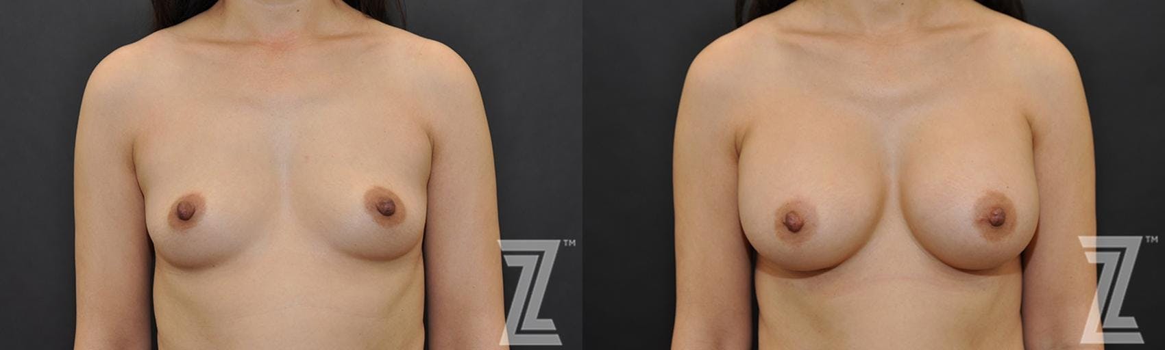 Breast Augmentation Before & After Gallery - Patient 132791042 - Image 1