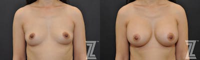 Austin Front view of Before & After image of woman with Silicone Implants with Highly Cohesive Gel (Gummy Bear Implants) - The Piazza Center