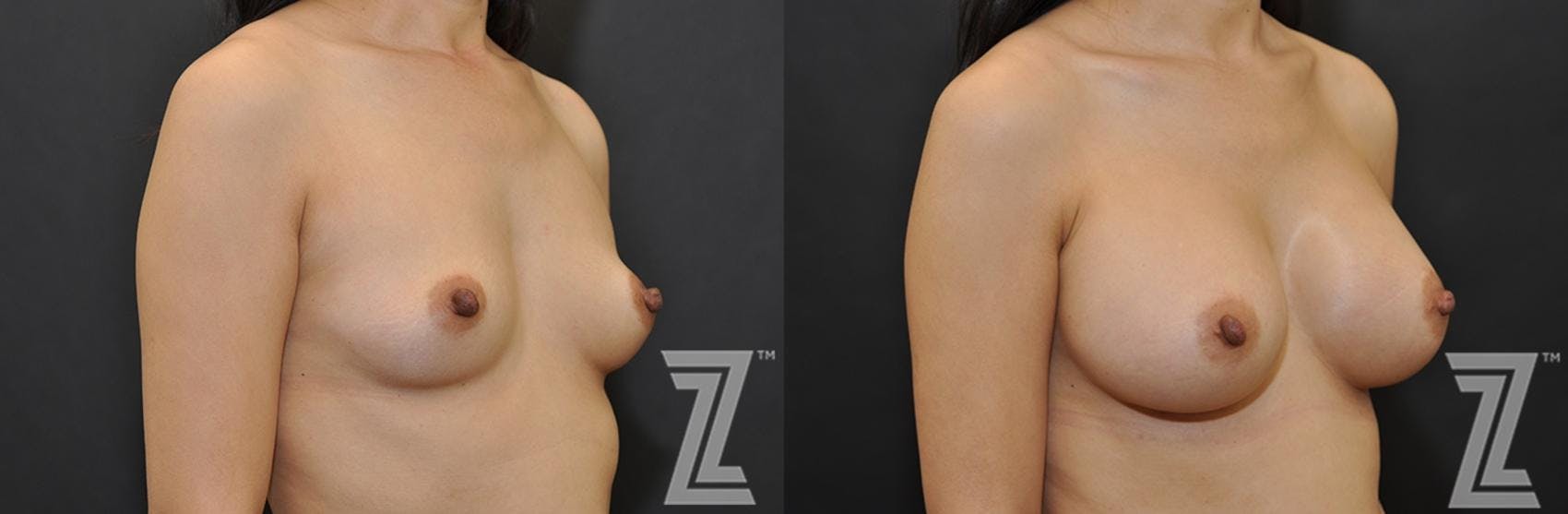 Breast Augmentation Before & After Gallery - Patient 132791042 - Image 4