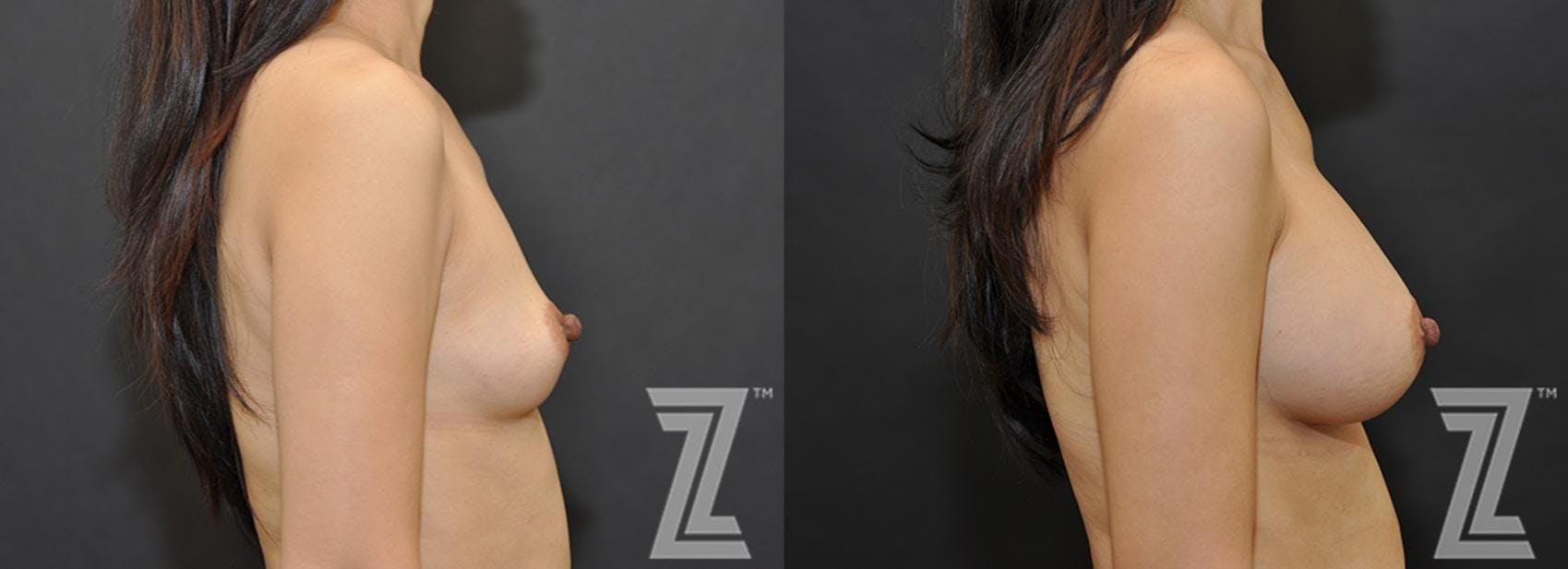 Breast Augmentation Before & After Gallery - Patient 132791042 - Image 5