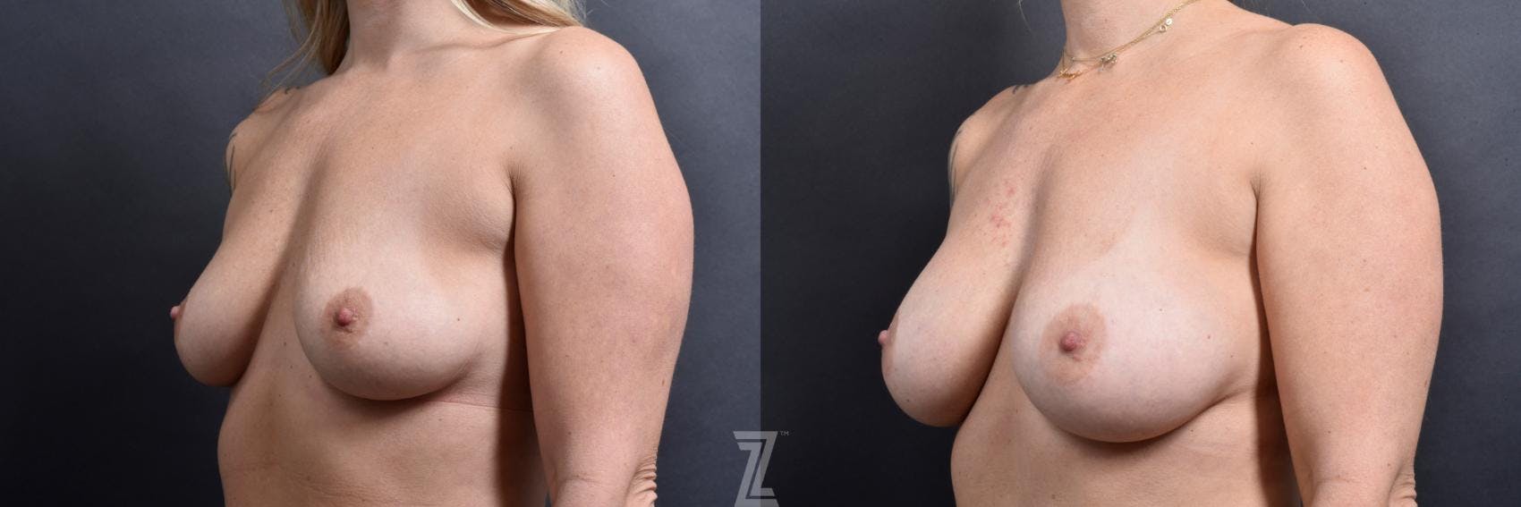 Breast Augmentation Before & After Gallery - Patient 132791043 - Image 2