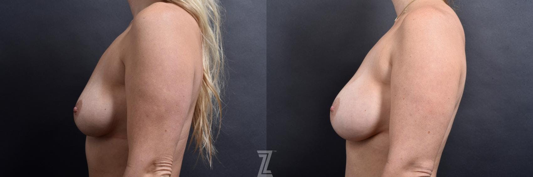 Breast Augmentation Before & After Gallery - Patient 132791043 - Image 3
