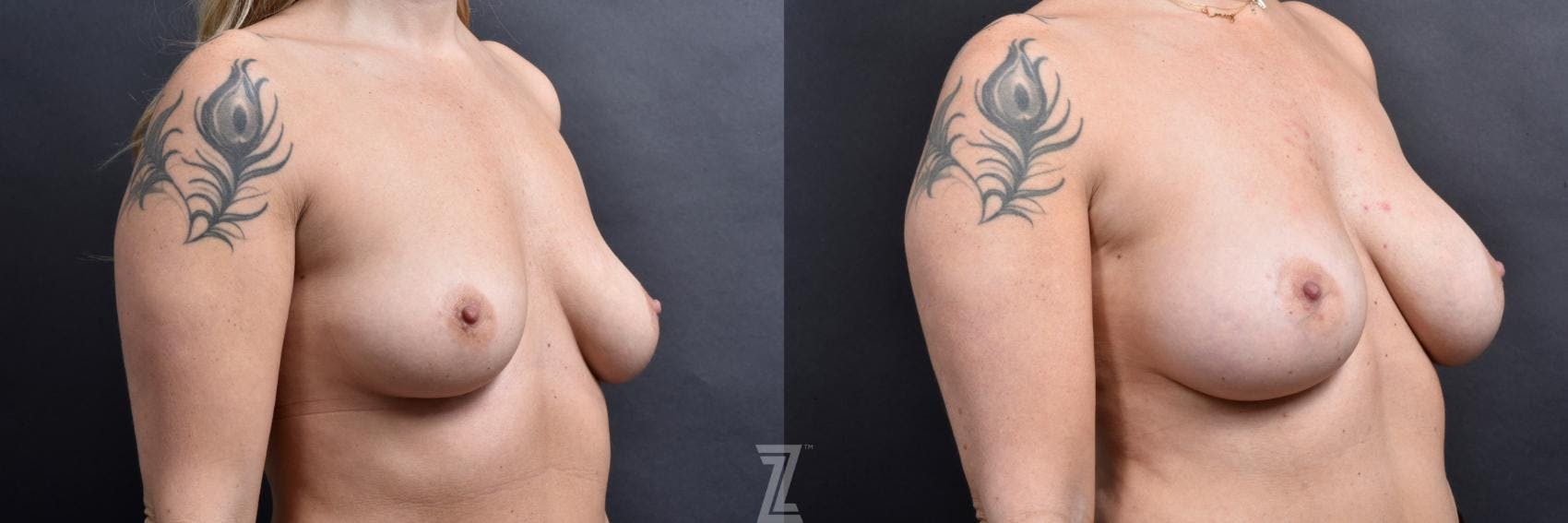 Breast Augmentation Before & After Gallery - Patient 132791043 - Image 4