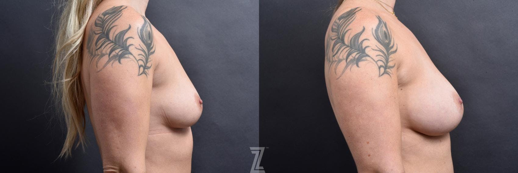 Breast Augmentation Before & After Gallery - Patient 132791043 - Image 5