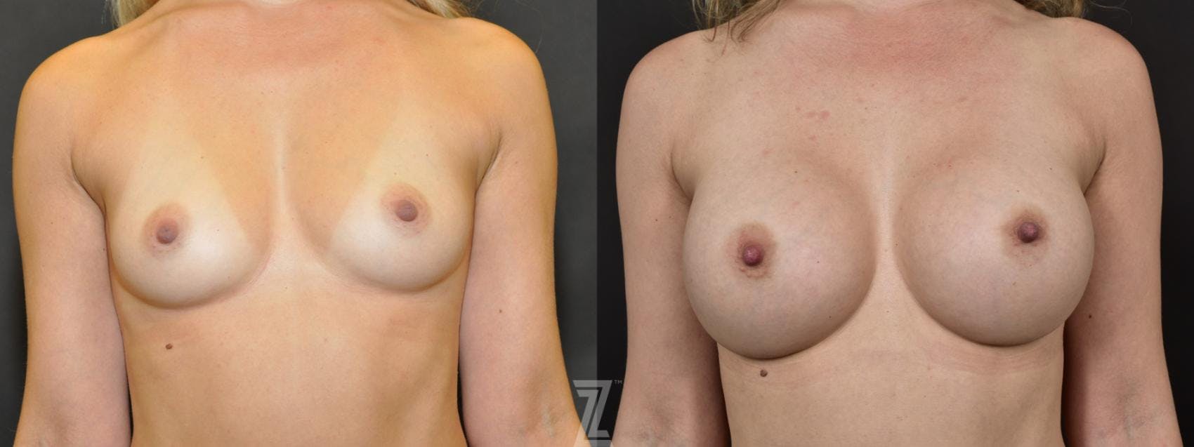 Breast Augmentation Before & After Gallery - Patient 132791044 - Image 1