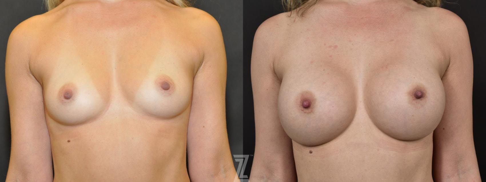 Breast Augmentation Before & After Gallery - Patient 132791044 - Image 1