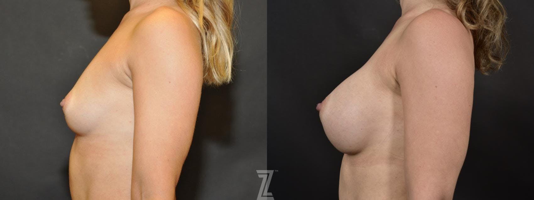 Breast Augmentation Before & After Gallery - Patient 132791044 - Image 3